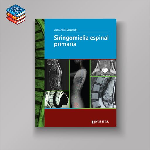 Siringomielia espinal primaria (High Quality Image PDF)